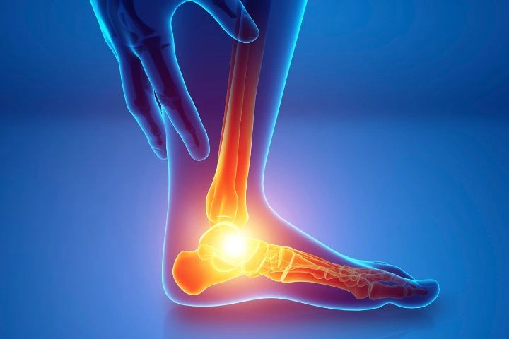 Modrá 3D anatomická ilustrace chodidla se svítícím bodem bolesti na patní kosti, která znázorňuje patní ostruhu.